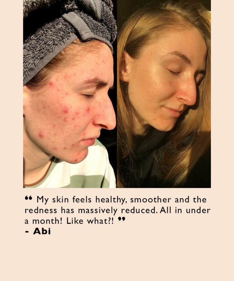 Acne-attacker Skincare Bundle